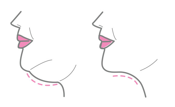 Doppelkinn entfernen Bad Dürkheim Doppelkinn entfernen Bad Dürkheim